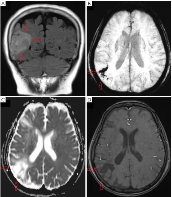 Figure 3 MRI scans showed cerebrovascular accident in some patients with/without delirium