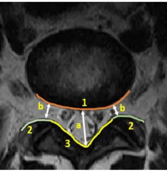 Figure 2.5: The three important boundaries for stenosis detection between AAP and 1) IVD,  2) Facet Joints, and 3) LF to measure a) the anteroposterior diameter of the spinal canal and 