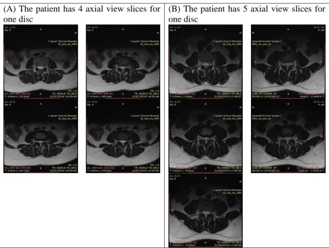 Figure 4.1: Illustrates an example for two different patients MRI (A) Four slices of images  for the level 3 disc