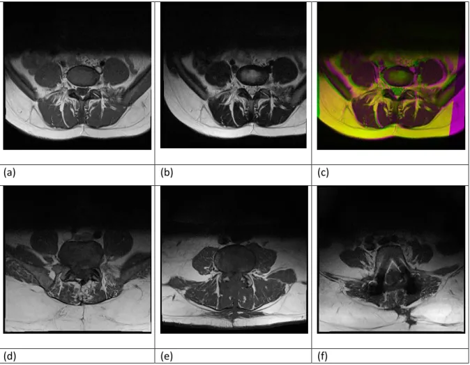 Figure 4.2 Some examples of the discarded MRI scans. Image (a) is T1-weighted and (b) T2- T2-weighted MRI scans of the same part of the lumbar spine of a patient