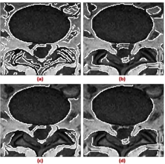 Figure 5.3: The results of Canny edge detection using a combination of two threshold values  and two sigma value where a) low threshold – low Gaussian width, b) low threshold – high 