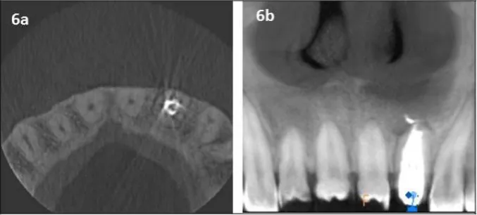 Figure 5a, 5b, 5c: Post-operative periapical radiography with three different angulations 