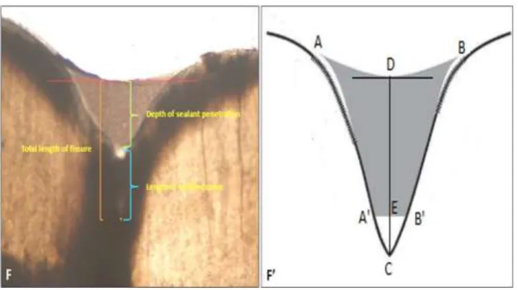 Table 1: Summary of penetrability and lateral wall adaptation of three different sealants and their distribution according to fissure patterns 