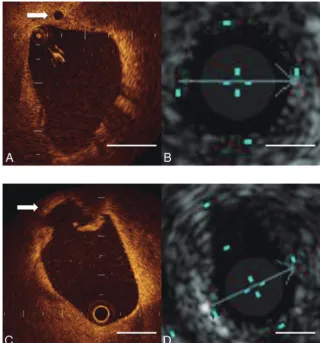 Fig 2. Representative images of neovascularization and ulceration of symptomatic carotid artery stenosis before CAS.microchannel structure without connection to the vessel lumen that was present inshow these findings.Bar A, OCT demonstrates neovascularizat