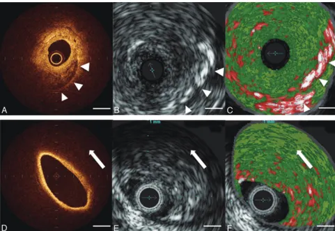 Fig 3. Representative images of a calcification and lipid-rich component before stent placement.mixed-signal-intensity region ( A, OCT demonstrates calcification as a heterogeneous, sharply delineatedarrowheads)