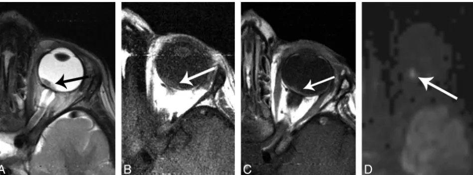 Fig 6. A 3-year-old boy with retinoblastoma, imaged at 3T. A, Axial T2-weighted image shows a small hypointense mass at the posterior globe near the optic nerve head