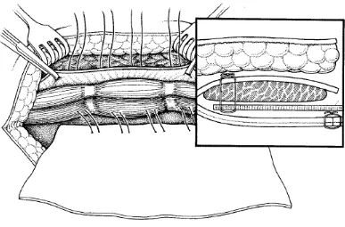 Figure 3 : After mesh placement in Rives - Stoppa repair 10 