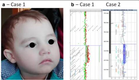 Fig. 1 Facial dysmorphism of case 1 and the array CGH profiles in both probands. a The details about facial dysmorphis are presented in Table 1;b The array CGH results are presented for both Case 1 and Case 2