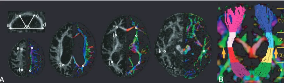 Fig 1. Region-of-interest analysis and tract-specific analysis of the CST.(b), the posterior third of the body (c), and splenium (d) on the sagittal section (FA map), the juxtacortical white matter in the frontal (e) and parietal cortices (f), the perivent