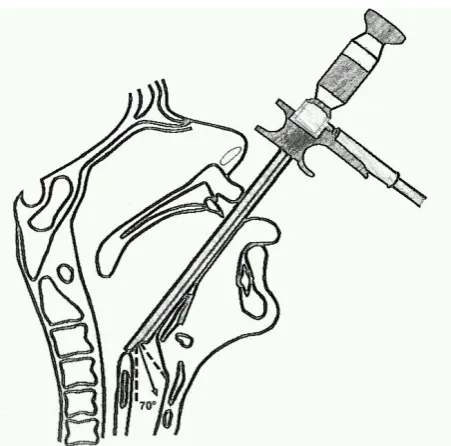 Fig 14-Endoscopic Procedure 