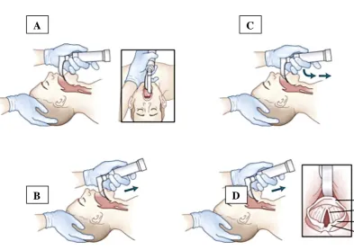 Figure 6CONVENTIONAL DIRECT LARYNGOSCOPY