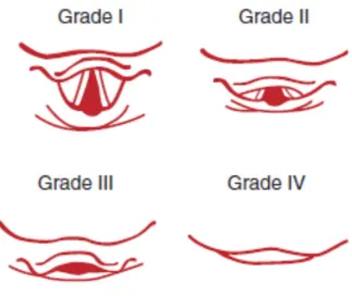 Figure 9CORMACK LEHANE (CL) GRADING SYSTEM OF