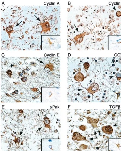 FIG. 3. Immunohistochemical analysis of cellular proteins in demyelinated plaques of PML and normal brain tissue