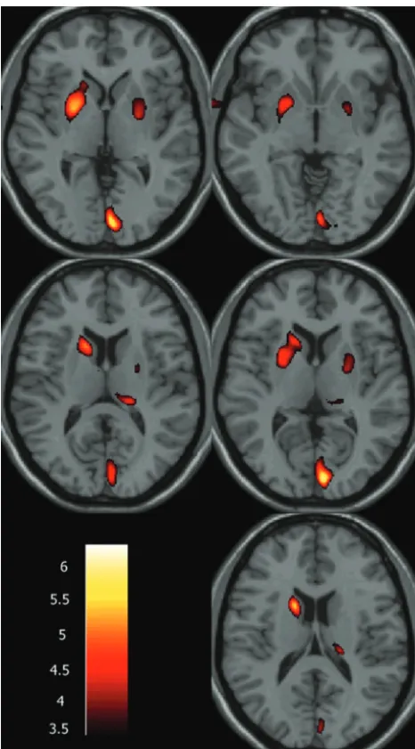 Fig 1. VBM findings of differences in GM volume between patients with POAG anddisease-free control subjects