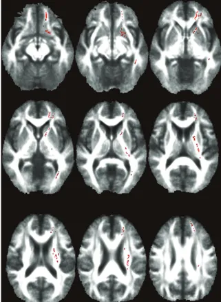 Fig 3. Voxel-based DTI results for differences in the FAindex between patients with POAG and disease-free con-trol subjects
