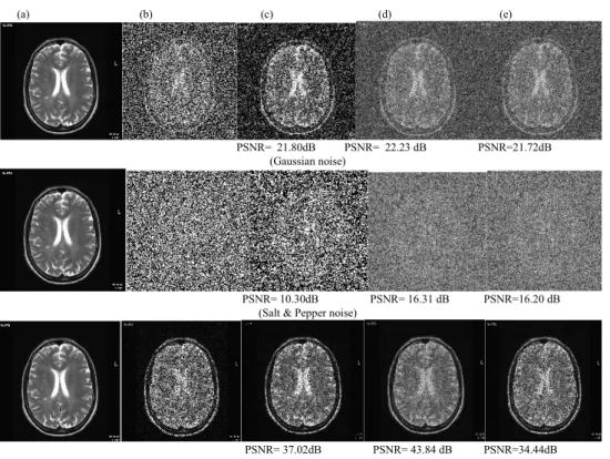 Fig 3 (a) Original MRI image (b) Noisy image (90% noise density) (c) Median filter (d) Average filter (e) Adaptive filter 