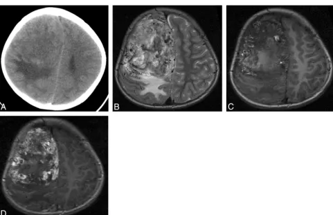 Fig 1. Patient 3. Hemangiopericytoma with peripheral calcification and bone erosion.to the temporal lobe