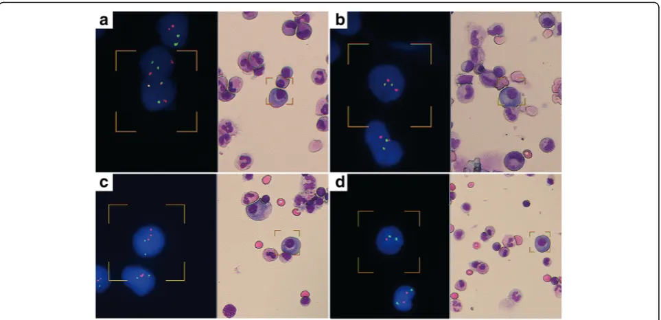 Fig. 2 Images of MGG stained (showing 3O2G signal pattern on the plasma cell positive for +1q21.right) and FISH probe hybridized (left) plasma cells