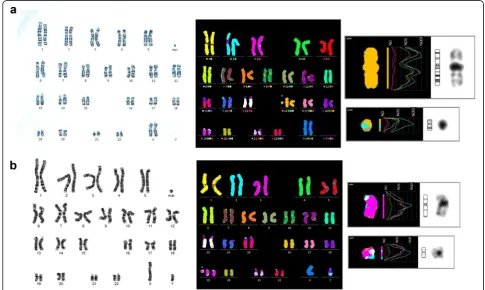 Fig. 6 Identification of the chromosomal origin of the sSMC(2) by FISH in case 13. FISH analysis with MYCN (2p24,3; spectrum red) probe andLAF4 (2q11.2; spectrum green) probe shows a green hybridization signal on the marker chromosome, indicating that it i