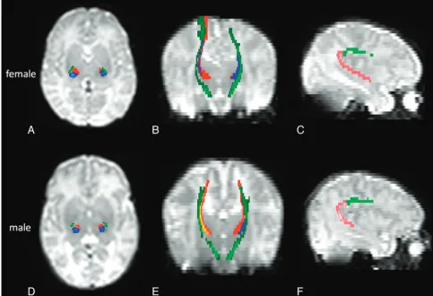 Fig 1. Sensorimotor and language-related tracts are shown on B0 images in a healthy preterm girl born at 31 weeks GA and imaged at 37 weeks GA ((GA and imaged at 37 weeks GA (A–C) and in a boy born at 30 weeksD–F)