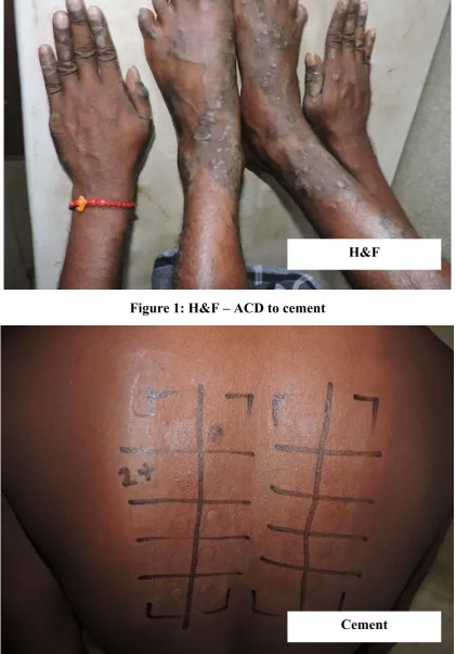 Figure 1: H&F – ACD to cement  