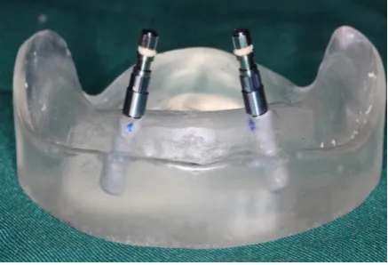 Figure 1: Insertion of each implant at a 15-degree angle in the definitive cast  