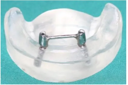 Figure 2: Angled abutments were placed within the definitive cast and then screwed to implants