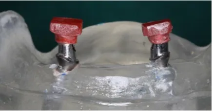 Figure 6: Group 2 open-tray non-splinted impression coping technique model  