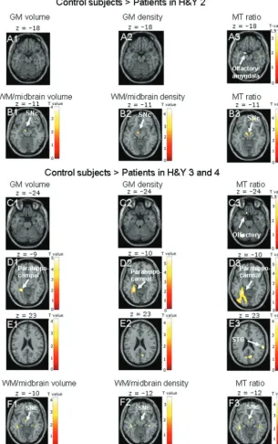 Fig 2. Results are presented at P � .001 whole-brain uncor-rected, for GM images, and P � .01, for midbrain images;significant effects are marked with arrows and labeled