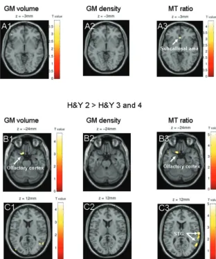 Fig 3. Results are presented at P � .001 whole-brain uncor-rected; significant effects are marked with arrows and labeled.A, The comparison of patients in H&Y stages 1 and 2 shows asignificant effect in the subcallosal area on MTR images (A3),but not on GM