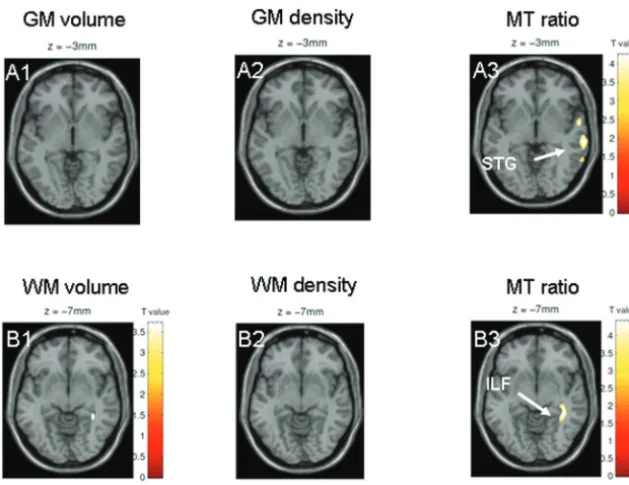Fig 4. Results are presented at( P � .001 whole-brainuncorrected; significant effects are marked with arrows andlabeled