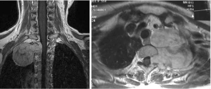 Fig. 2. Plain radiography of the chest revealed a circular-shaped shadow of the left, upper portion of the lung and left T2 pedicle sign.