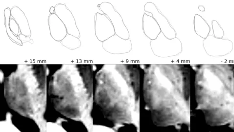 Fig 6. Optimized MPRAGE (bottom row) and nucleus groups in axial sections parallel to the ACPC line (from left to right: apical to caudal sections; position given in millimeters relativeto the ACPC line) selected by the first and second readers (top row, light and dark gray lines).