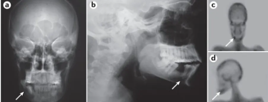 Figure 6. Overt bone disease in PHPT