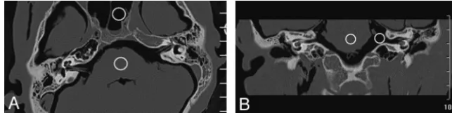 Fig 1. ROIs in the brain stem and air were used to calculate the CNR for each image. Example ROIs are shown in an axial (A) and the coronal (B) reformatted images here.