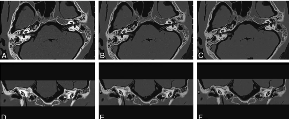 Table 4: Radiation dose indices, noise, and CNR of temporal bone helical scans with different effective tube mAs