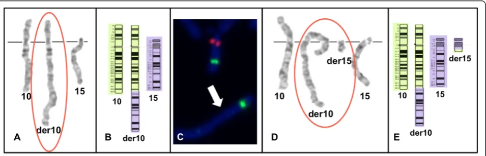 Figure 1 Available family members. A) Pedigree of the proband and her family; B) Proband (III-1) with telecanthus, bilateral epicanthal folds,wide mouth, and an apparently happy demeanor; hands with tapered fingers, abnormal creases and broad thumbs.