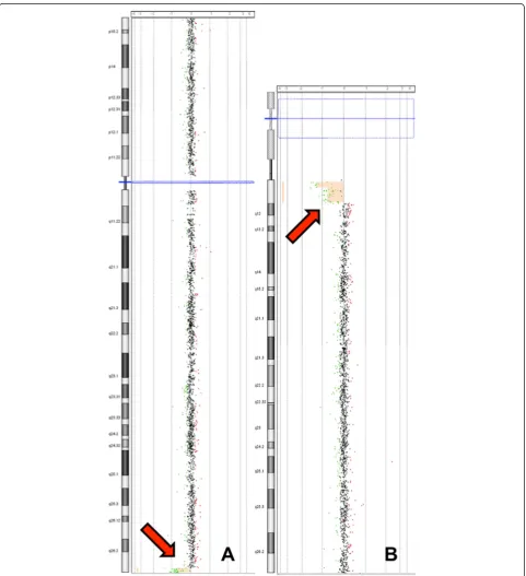 Figure 3 Array CGH analysis results of the proband (III-1). 45,XX,der(10)t(10;15)(q26.3;q11.2),-15 mat.arr[hg19] 10q26.3(134,339,232-135,404,471)x1,15q11.1q11.2(20,481,702-25,582,821)x1; A) Chromosome 15; B) Chromosome 10.