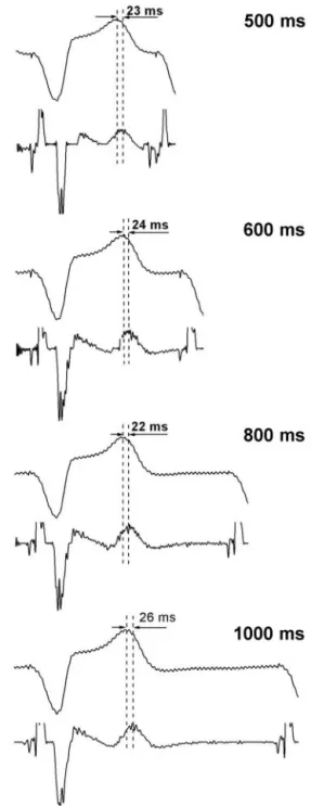 Figure 3 shows the ECG and the derivative of the electrogram at multiple paced cycle lengths from a single patient