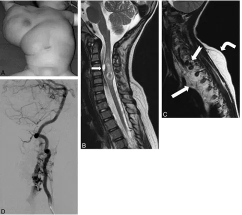 Fig 1.layer (bent arrowvia the C3, C4, and C5 segmental branches of the right vertebral artery