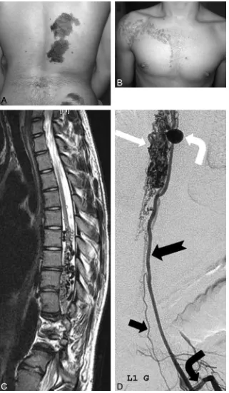 Fig 2. Airregular contour due to the intradural dilated vessels, with focal hyperintense changes