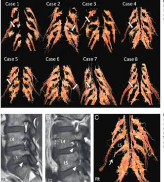 Fig 5. Tractograms of 8 patients by placing secondary ROI onthe distal side of the foramen