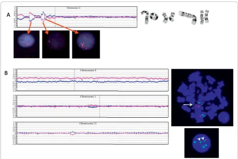 Figure 1 FISH confirmation studies. A) Four different chromosome 12 abnormalities in patient #1 and the corresponding aCGH plot