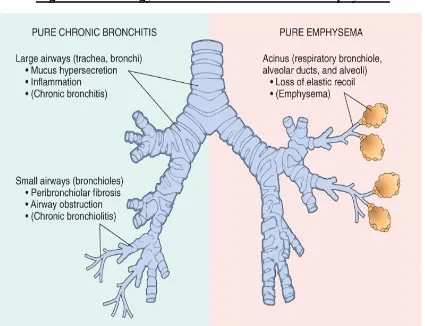 Figure 1. Pathology of Chronic Bronchitis and Emphysema 