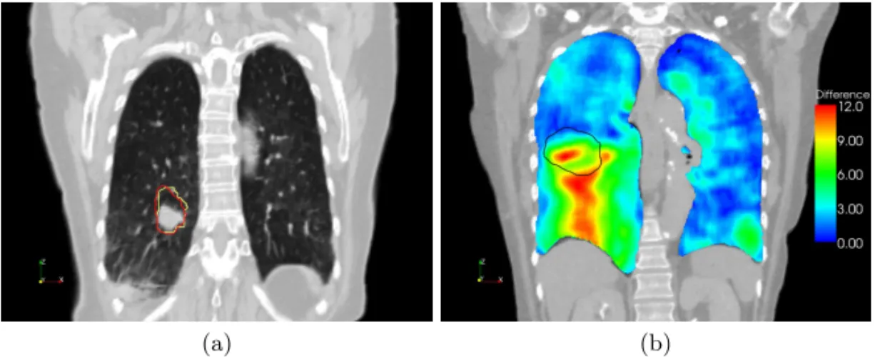 Fig. 3. (a) Visualization of the internal target volume (ITV) of patient 01 in a coronal CT slice