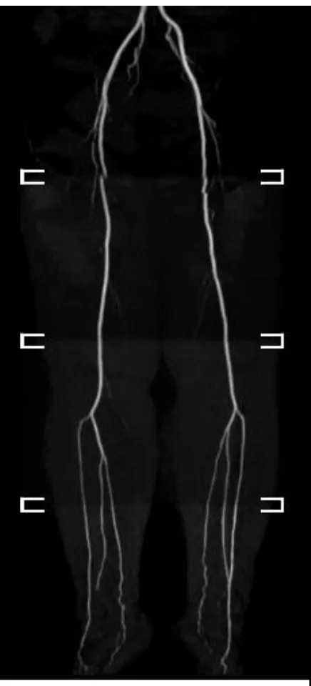 Fig.6: Non- contrast MR angiography in a patient with no evidence of peripheral arterial disease