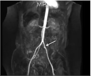 Fig.7: Contrast MR Angiography: Grade 1 stenosis in the left common iliac artery 