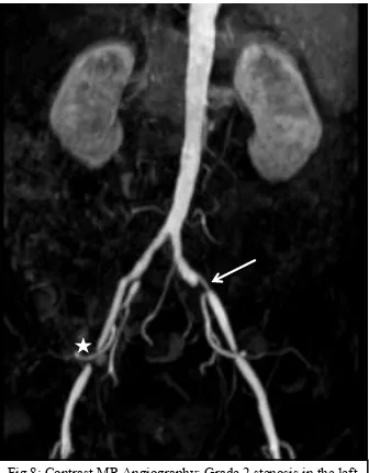 Fig.8: Contrast MR Angiography: Grade 2 stenosis in the left common iliac artery, with grade 3 stenosis in the right external iliac artery (*)