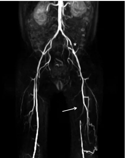 Fig.9: Contrast MR angiography: Grade 3 stenosis (occlusion) in the left superficial femoral artery and grade 2 stenosis in left external iliac artery(*)
