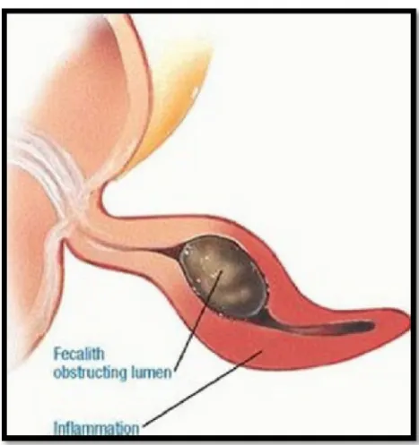 Figure 7. Faecolith causing obstructive appendicitis